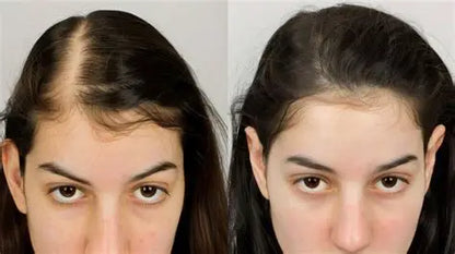 SUERO PARA EL CRECIMIENTO DEL CABELLO, 5% MINOXIDIL Y BIOTINA